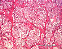 Prostate cancer under the microscope